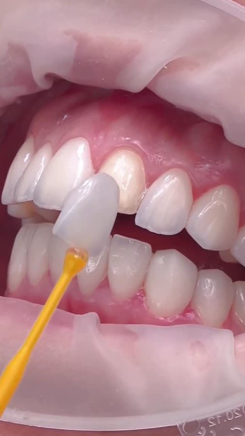 Clinica Dental Indacochea (Matriz) Diseño de Sonrisas